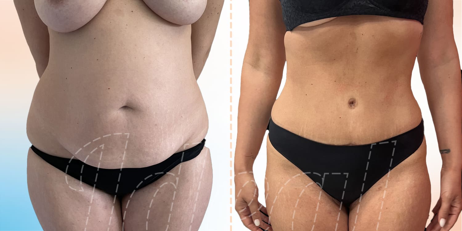 Addominoplastica-Paziente-2-1_c Risultato intervento addominoplastica + Correzione diastasi dei muscoli retti + liposcultura addome e fianchi e arti inferiori vista frontalmente, prima e dopo operazione del Dr. Vincenzo Nunziata