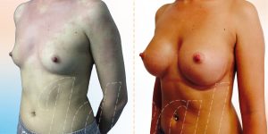 Risultato intervento mastoplastica additiva sotto muscolare con tecnica “DUAL PLANE” vista lateralmente da sinistra, prima e dopo operazione del Dr. Vincenzo Nunziata